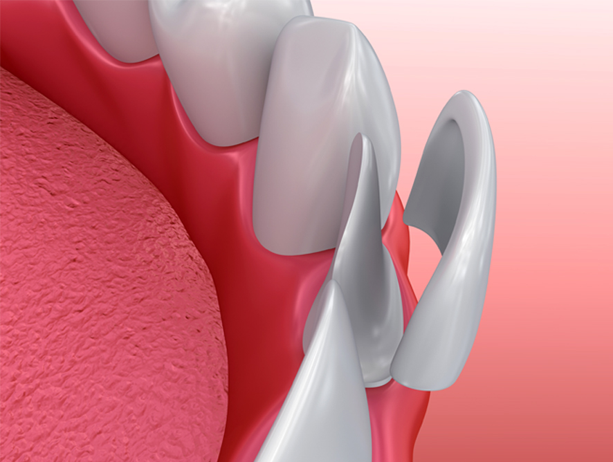 Facettes, couronnes et ponts